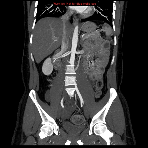 File:Circumaortic left renal vein (Radiopaedia 9069-9792 B 18).jpg
