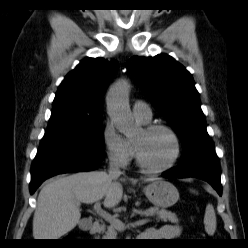 File:Classic complicated silicosis (Radiopaedia 49720-54961 Coronal liver window 20).jpg