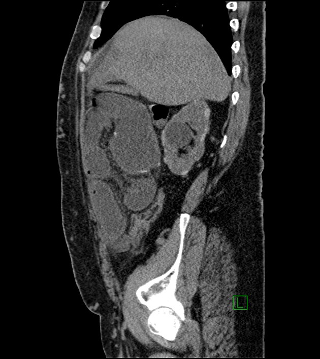 Closed-loop small bowel obstruction-internal hernia (Radiopaedia 78439-91096 C 107).jpg