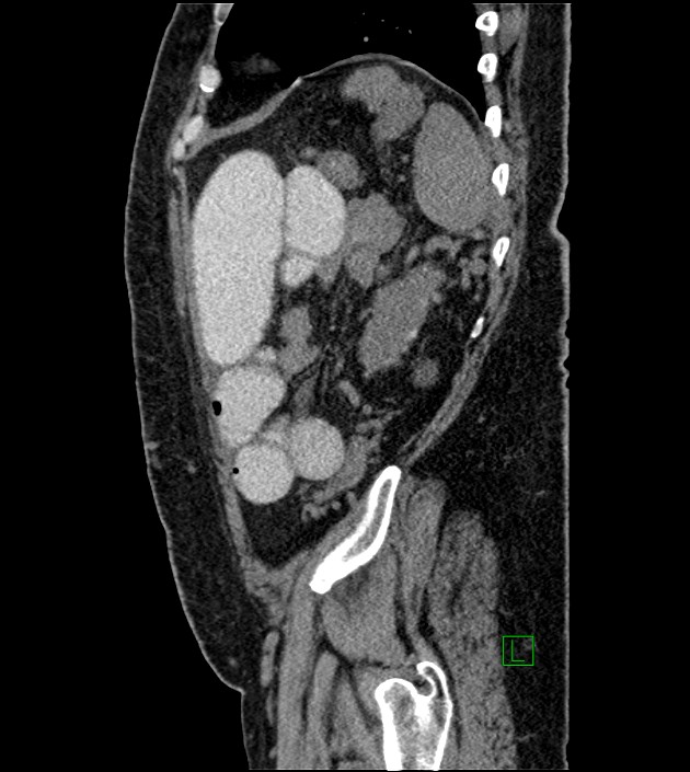 Closed-loop small bowel obstruction-internal hernia (Radiopaedia 78439-91096 C 37).jpg