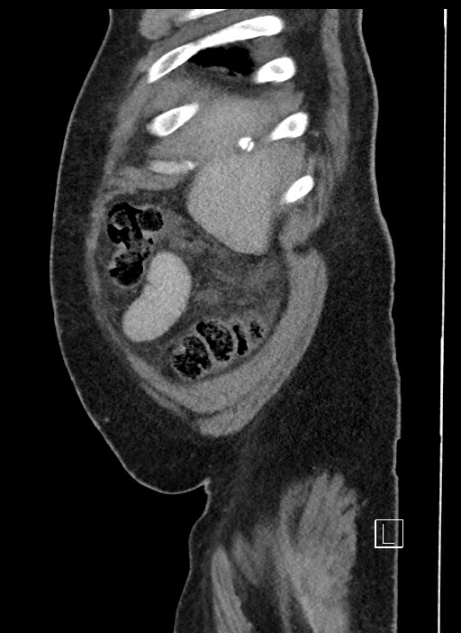 Closed loop obstruction - internal hernia into nephrectomy bed (Radiopaedia 59867-67320 C 101).jpg