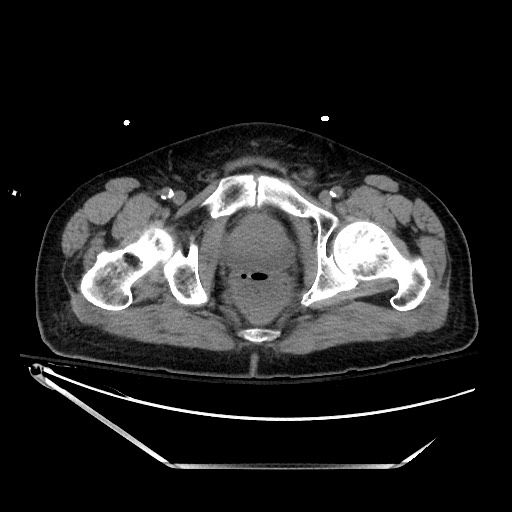 File:Closed loop obstruction due to adhesive band, resulting in small bowel ischemia and resection (Radiopaedia 83835-99023 Axial non-contrast 152).jpg