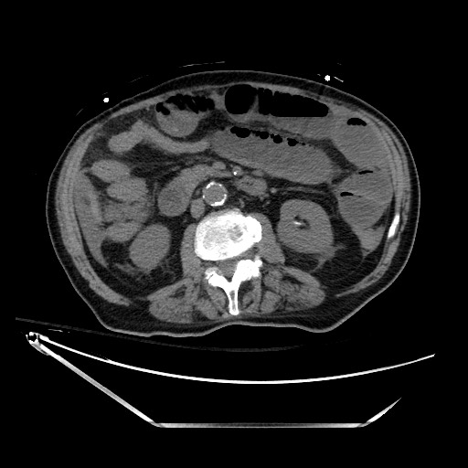 Closed loop obstruction due to adhesive band, resulting in small bowel ischemia and resection (Radiopaedia 83835-99023 Axial non-contrast 70).jpg