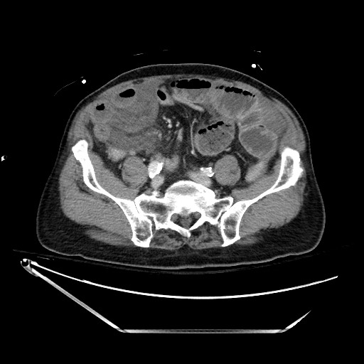 File:Closed loop obstruction due to adhesive band, resulting in small bowel ischemia and resection (Radiopaedia 83835-99023 D 109).jpg