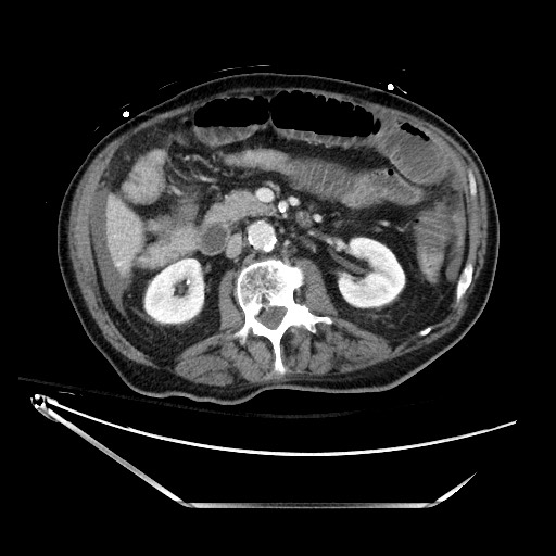 Closed loop obstruction due to adhesive band, resulting in small bowel ischemia and resection (Radiopaedia 83835-99023 D 66).jpg