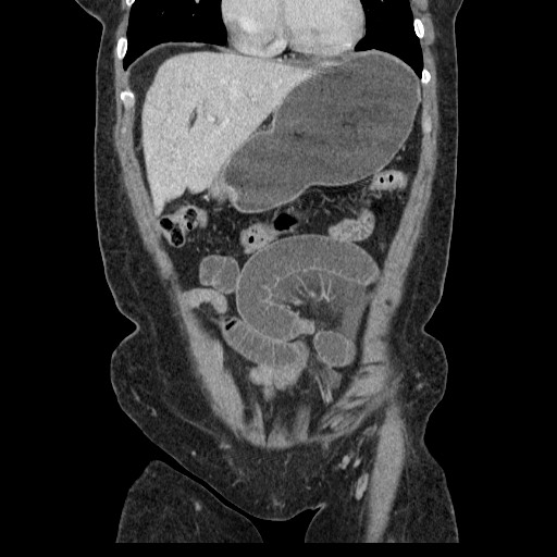 File:Closed loop small bowel obstruction (Radiopaedia 65403-74451 B 36).jpg