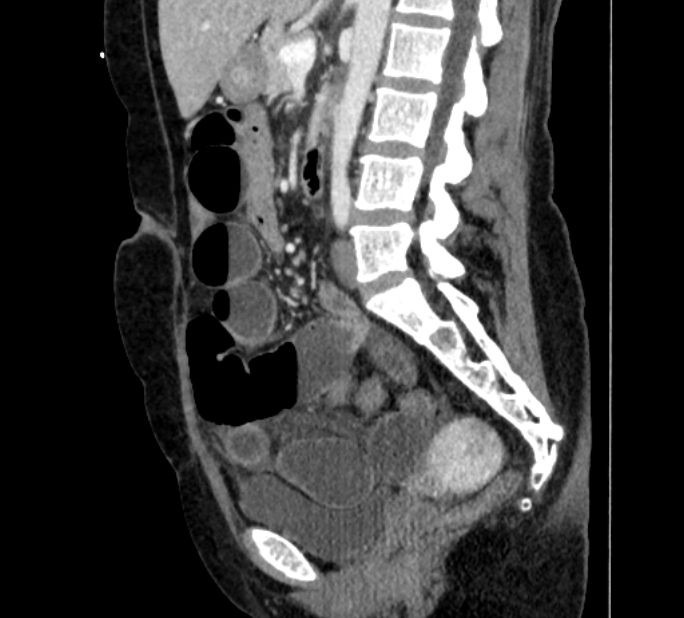 Closed loop small bowel obstruction (Radiopaedia 71211-81508 C 80).jpg