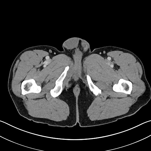 Closed loop small bowel obstruction - internal hernia (Radiopaedia 57806-64778 B 142).jpg