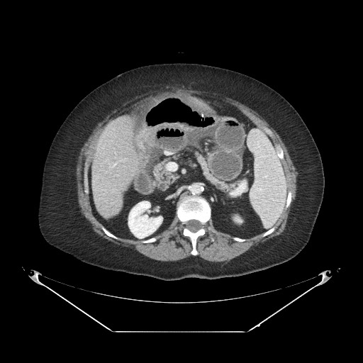 Closed loop small bowel obstruction - internal hernia (Radiopaedia 65402-74450 A 44).jpg