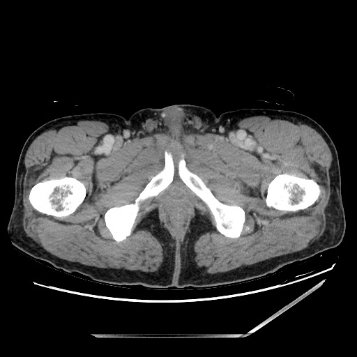 Closed loop small bowel obstruction - omental adhesion causing "internal hernia" (Radiopaedia 85129-100682 A 182).jpg