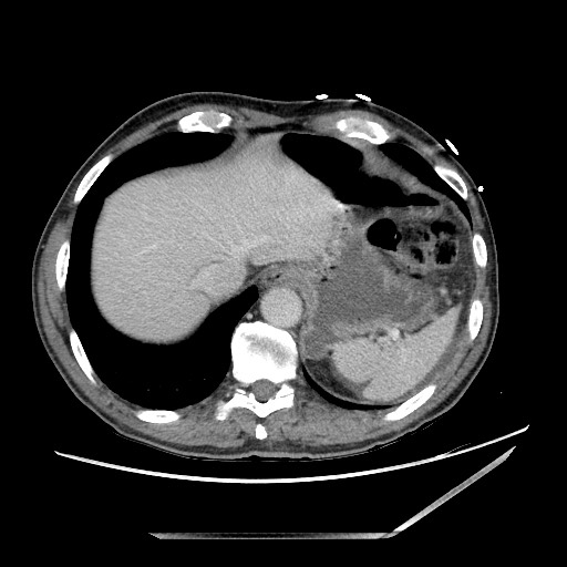 Closed loop small bowel obstruction - omental adhesion causing "internal hernia" (Radiopaedia 85129-100682 A 20).jpg