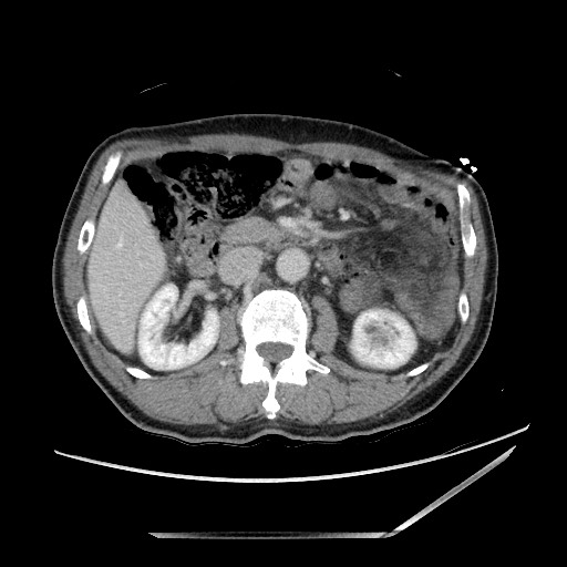 File:Closed loop small bowel obstruction - omental adhesion causing "internal hernia" (Radiopaedia 85129-100682 A 65).jpg