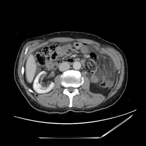 Closed loop small bowel obstruction - omental adhesion causing "internal hernia" (Radiopaedia 85129-100682 A 74).jpg