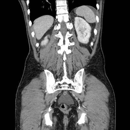 Closed loop small bowel obstruction - omental adhesion causing "internal hernia" (Radiopaedia 85129-100682 B 101).jpg