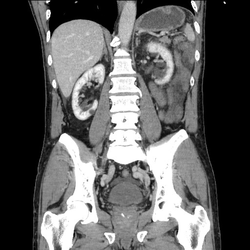 Closed loop small bowel obstruction - omental adhesion causing "internal hernia" (Radiopaedia 85129-100682 B 81).jpg