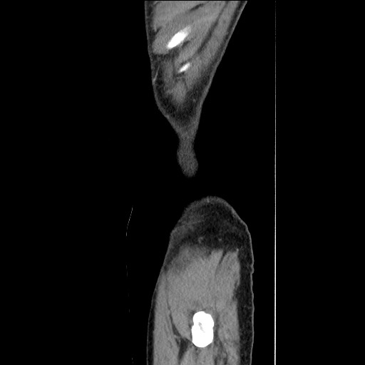File:Closed loop small bowel obstruction - omental adhesion causing "internal hernia" (Radiopaedia 85129-100682 C 18).jpg