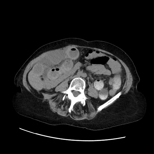 Closed loop small bowel obstruction due to adhesive band, with intramural hemorrhage and ischemia (Radiopaedia 83831-99017 Axial non-contrast 90).jpg