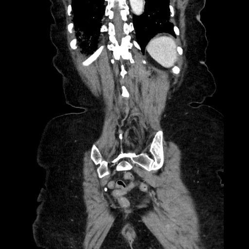 Closed loop small bowel obstruction due to adhesive band, with intramural hemorrhage and ischemia (Radiopaedia 83831-99017 C 104).jpg
