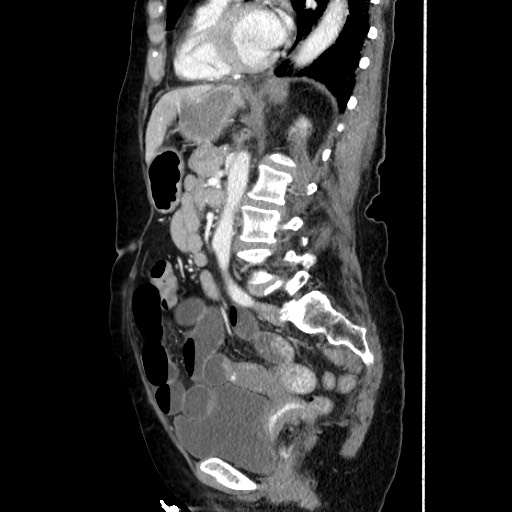 Closed loop small bowel obstruction due to adhesive band, with intramural hemorrhage and ischemia (Radiopaedia 83831-99017 D 116).jpg