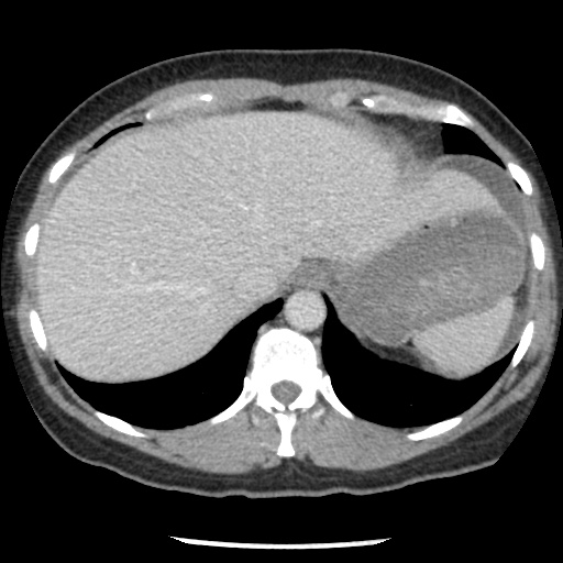 File:Closed loop small bowel obstruction due to trans-omental herniation (Radiopaedia 35593-37109 A 19).jpg