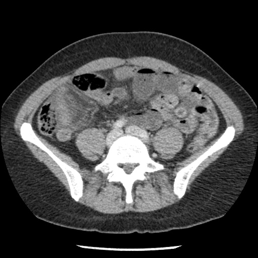 Closed loop small bowel obstruction due to trans-omental herniation (Radiopaedia 35593-37109 A 57).jpg