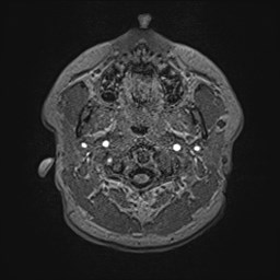 File:Cochlear incomplete partition type III associated with hypothalamic hamartoma (Radiopaedia 88756-105498 Axial T1 17).jpg