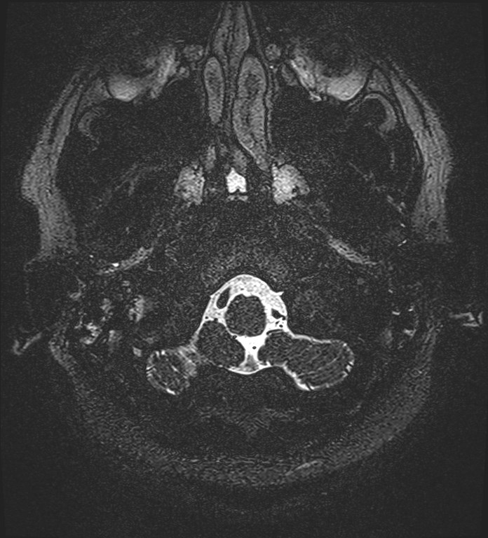 Cochlear incomplete partition type III associated with hypothalamic hamartoma (Radiopaedia 88756-105498 Axial T2 13).jpg