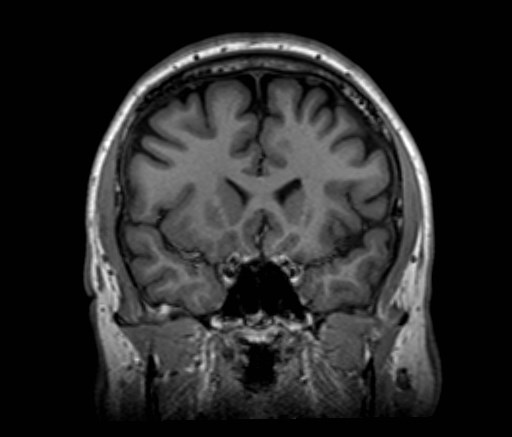 File:Cochlear incomplete partition type III associated with hypothalamic hamartoma (Radiopaedia 88756-105498 Coronal T1 42).jpg
