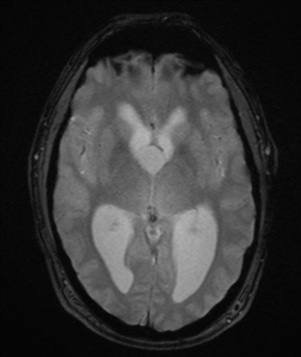 File:Colloid cyst (Radiopaedia 44510-48181 Axial Gradient Echo 13).png