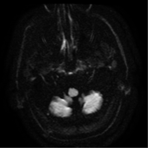 File:Colloid cyst (large) (Radiopaedia 34415-35729 Axial DWI 2).png