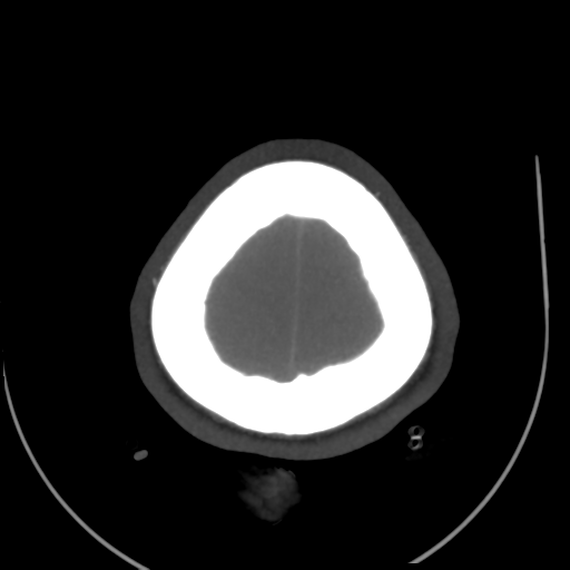 File:Colloid cyst (resulting in death) (Radiopaedia 33423-34499 A 53).png