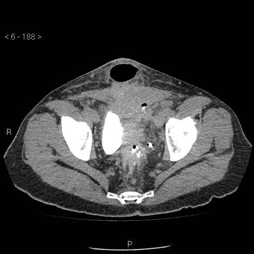File:Colo-cutaneous fistula (Radiopaedia 40531-43129 A 78).jpg