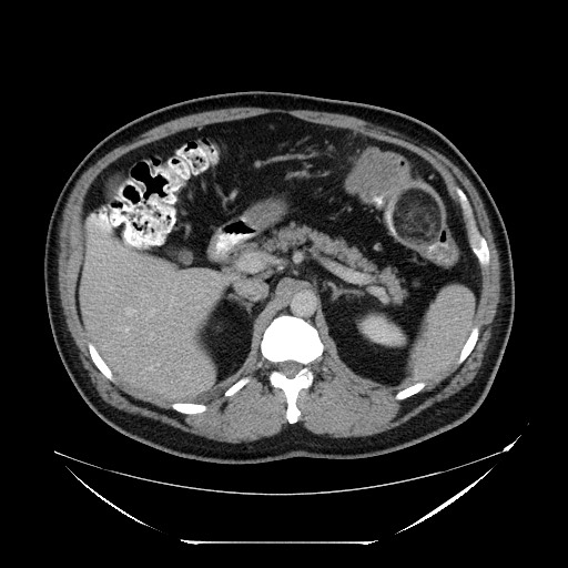 File:Colocolic intussusception due to lipoma (Radiopaedia 73712-84508 Axial 3).jpg