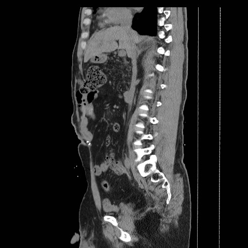 File:Colocutaneous fistula in Crohn's disease (Radiopaedia 29586-30093 C 18).jpg