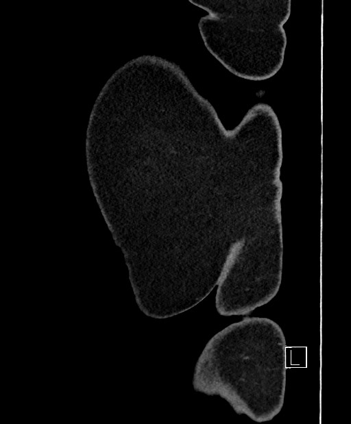 Colon adenocarcinoma (Radiopaedia 59374-66735 C 3).jpg