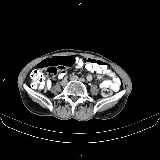File:Colon adenocarcinoma - hepatic flexure (Radiopaedia 85635-101395 Axial C+ delayed 60).jpg