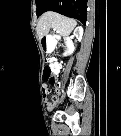 Colon adenocarcinoma - hepatic flexure (Radiopaedia 85635-101395 D 28).jpg