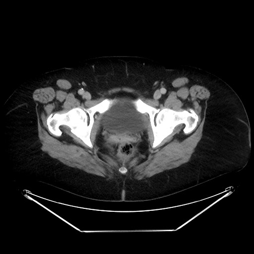 File:Colonic intussusception due to adenocarcinoma (Radiopaedia 86828-102987 A 144).jpg