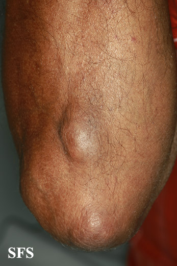 File:Gout (Dermatology Atlas 7).jpg