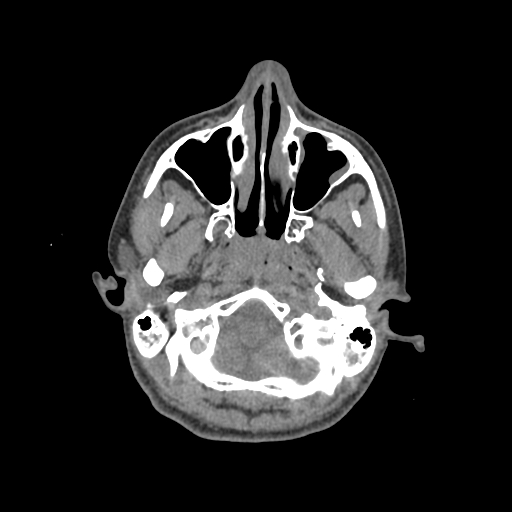File:Nasal pyogenic granuloma (lobular capillary hemangioma) (Radiopaedia 85536-101244 Axial non-contrast 49).jpg