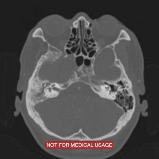 File:Nasopharyngeal carcinoma recurrence - skull base destruction (Radiopaedia 29107-29490 Axial bone window 82).jpg