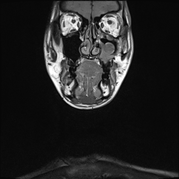 Nasopharyngeal carcinoma with skull base invasion (Radiopaedia 53415-59485 Coronal T1 34).jpg