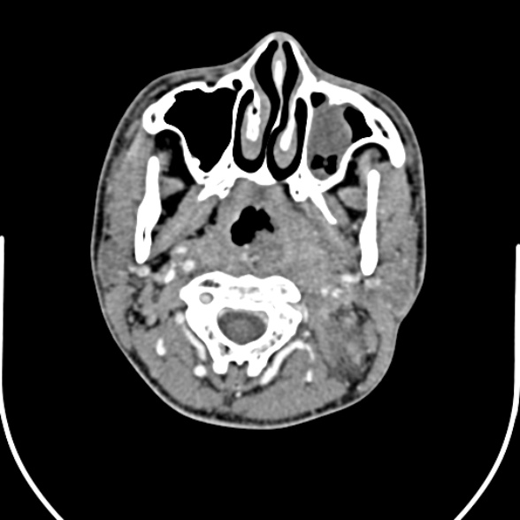 Nasopharyngeal carcinoma with skull base invasion (Radiopaedia 53415-59705 A 65).jpg