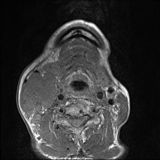 Nasopharyngeal carcinoma with skull base invasion (Radiopaedia 59258-66600 B 48).jpg