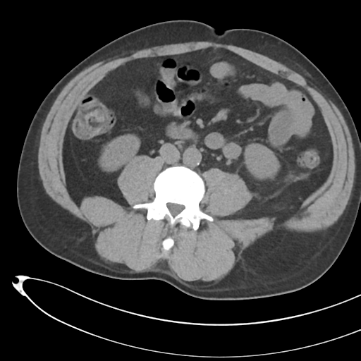 File:Necrotizing pancreatitis with acute necrotic collections (Radiopaedia 38829-41012 Axial non-contrast 47).png