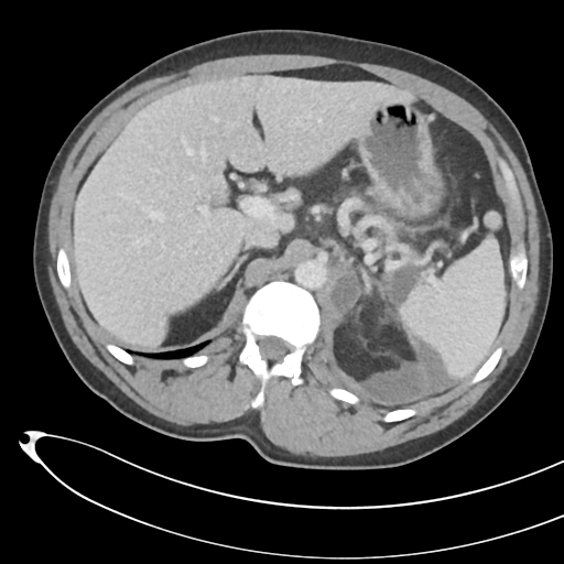 File:Necrotizing pancreatitis with acute necrotic collections (Radiopaedia 38829-41012 B 24).png