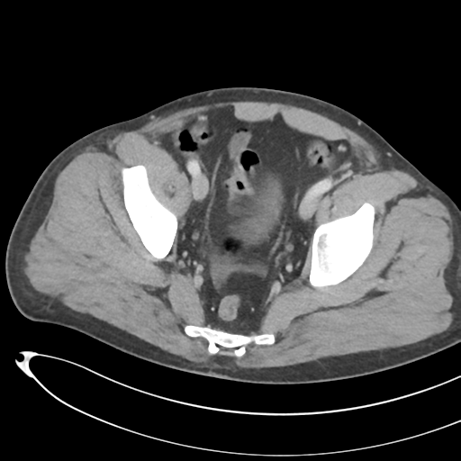 File:Necrotizing pancreatitis with acute necrotic collections (Radiopaedia 38829-41012 B 73).png
