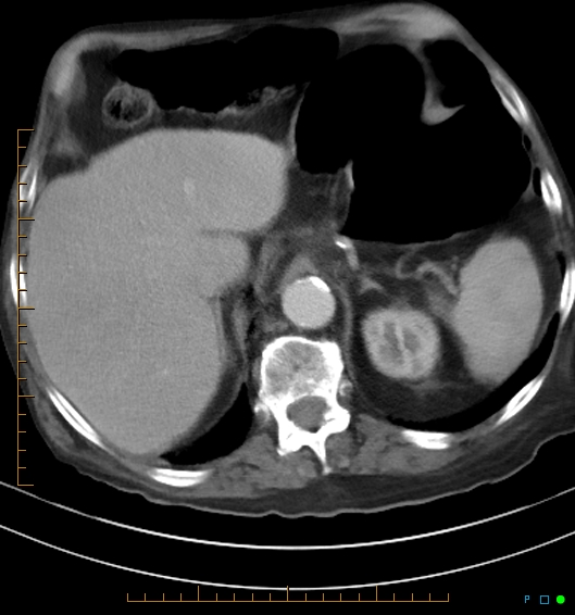 Necrotzing fasciitis due to a perforated adenocarcinoma of the splenic flexure (Radiopaedia 46930-51455 A 19).jpg