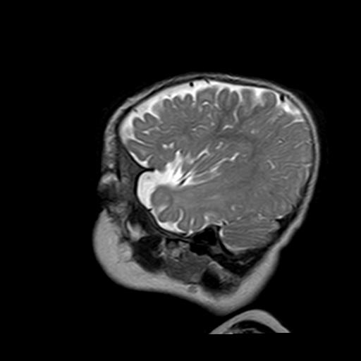 File:Neurofibromatosis type 1 (Radiopaedia 30089-30671 Sagittal T2 17).jpg