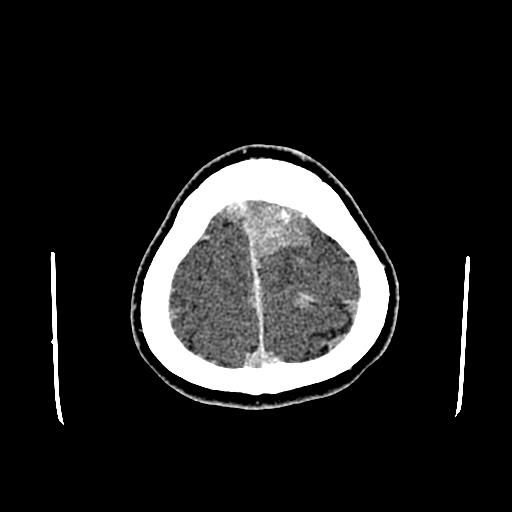 File:Neurofibromatosis type 2 (Radiopaedia 25389-25637 Axial C+ 92).jpg